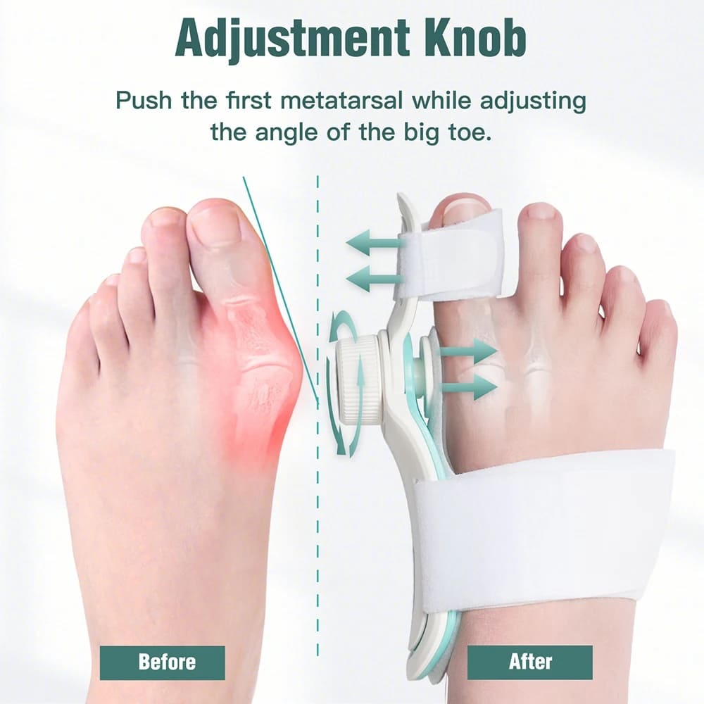 Dụng cụ chỉnh hình bunion, dụng cụ chỉnh hình hallux valgus ở bàn chân